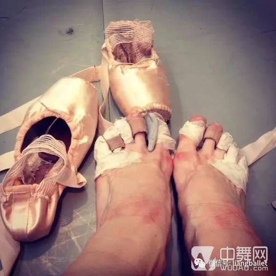 芭蕾舞脚变形流血图片图片